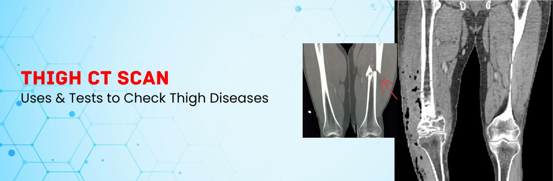 Thigh CT Scan and Its Uses